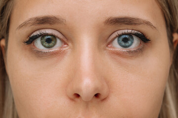 Cropped shot of a young woman's face with with eyes of different colors: green and blue. Close up...