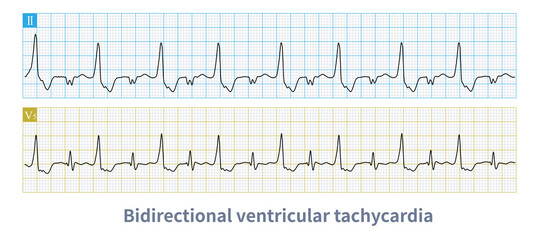 Bidirectional ventricular tachycardia is a kind of malignant arrhythmia. The polarity of QRS main wave alternates from beat to beat, and it is easy to degenerate into ventricular fibrillation. - obrazy, fototapety, plakaty