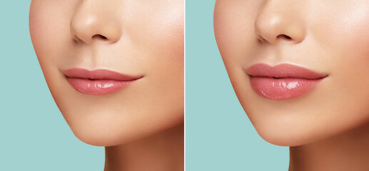 Comparison of Women lips correction before and after Hyaluronic acid injection. Injected and non-injected lips. Beauty lip treatment procedure. Natural lips shape. Lips Augmentation - obrazy, fototapety, plakaty