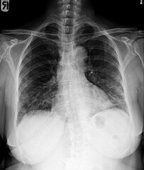 Film chest x-ray of normal woman chest .
