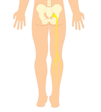 Sciatica - Sciatic Nerve Pain Illustration In The Right Leg 