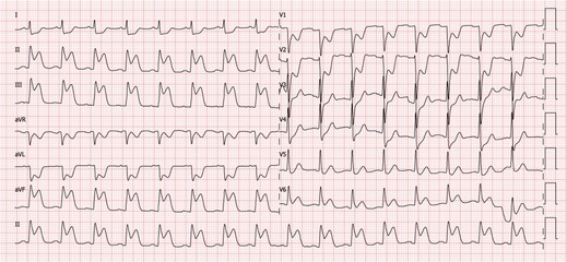 inferior miyocardial infarction findings on electrocardiogram