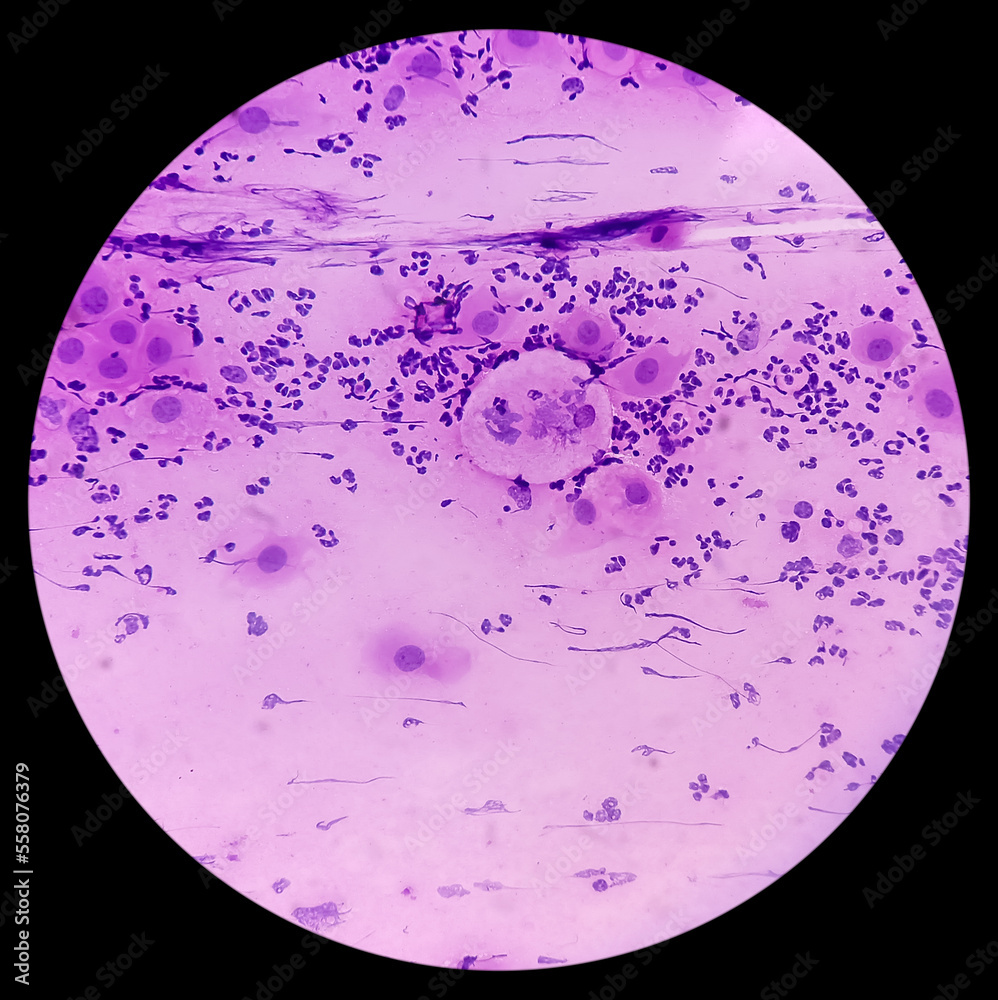 Poster Pap's smear. Reactive cellular changes associated with severe inflammation. Atrophic changes(Bethesda cervical reporting system). Cervical cancer screening. Abnormal squamous epithelial cells.