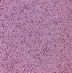 Photomicrograph close view of Abnormal urine analysis under light microscope. Epithelial cell, Pus cell, RBC. UTI(urinary tract infection).