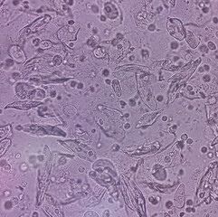 Photomicrograph close view of Abnormal urine analysis under light microscope. Epithelial cell, Pus...