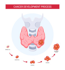 Fototapeta na wymiar Thyroid cancer development process