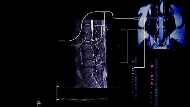 MRI Lumbar Back Bones hi- tech Screen with data and diagnostic analysis