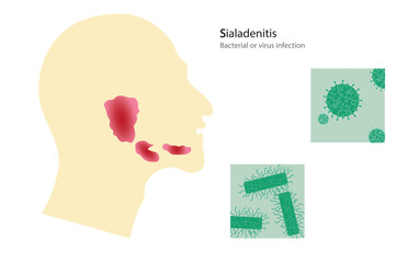 Sialadenitis - salivary gland inflamation caused by a virus or bacterial infection