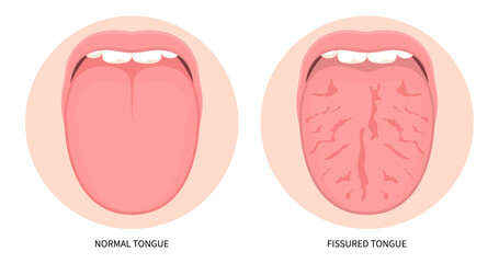 Fissured oral mouth pain cancer ulcer swelling inflamed angular canker sore viral pink trauma burnt throat tonsils gums dry of hunter median celiac iron virus fungal B12 anemia immune system red fever