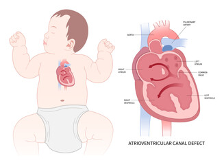 Baby with septum endocarditis congestive pulmonary hypertension - obrazy, fototapety, plakaty