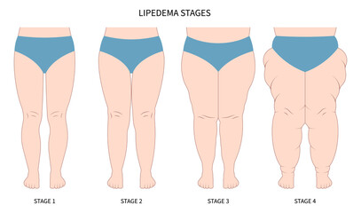 leg lipedema weight loss for Oedema and lipoedema cellulitis