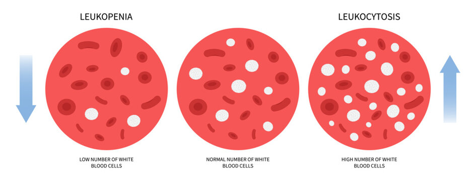 Anemia Basophilia basophils disorder with Low and high white Blood Cell Count for thrombocytosis