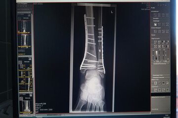 X-ray shows a fracture of the ankle joint, which was treated with plates and screws