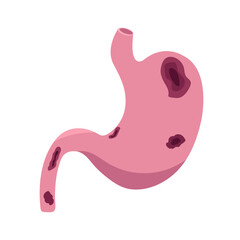 Illustrative image of peptic ulcer. Stomach with peptic ulcer.