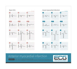 At present, there is a younger trend in patients with acute myocardial infarction, so it is important to check the ECG for acute chest pain in young people.