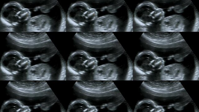 Multi-screen ultrasound of a small baby at 12 weeks. 12 weeks pregnant ultrasound echography showing baby or fetus development and pregnancy health checking