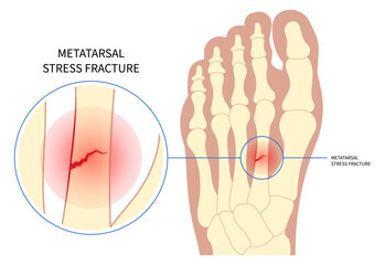 Density scan of foot bone heel toes trauma painful displaced and Chopart's five athletes - obrazy, fototapety, plakaty