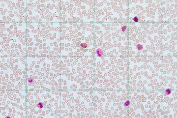 Blood smear Against the background of erythrocytes are different types of leukocytes