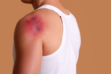 Man with bruise on shoulder against beige background, closeup