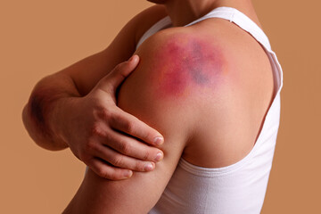 Man with bruise on shoulder against beige background, closeup - obrazy, fototapety, plakaty