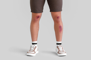 Man with bruises on legs against light background