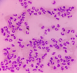 Microscopic finding, Neutrophilic leukocytosis with thrombocytosis, increase total count of White blood cell and increase number of neutrophils.