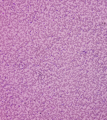 Fototapeta na wymiar Microscopic finding, Neutrophilic leukocytosis with thrombocytosis, increase total count of White blood cell and increase number of neutrophils.