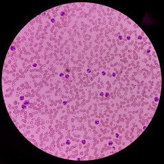 Microscopic finding, Neutrophilic leukocytosis with thrombocytosis, increase total count of White...
