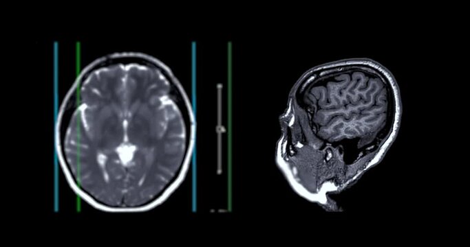 MRI Brain Sagittal T1W with axial t2W  can help doctors look for conditions such as bleeding, swelling, tumors, infections, inflammation, damage from an injury or a stroke diseases.