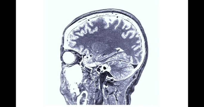 MRI Brain Sagittal T1W can help doctors look for conditions such as bleeding, swelling, tumors, infections, inflammation, damage from an injury or a stroke diseases.