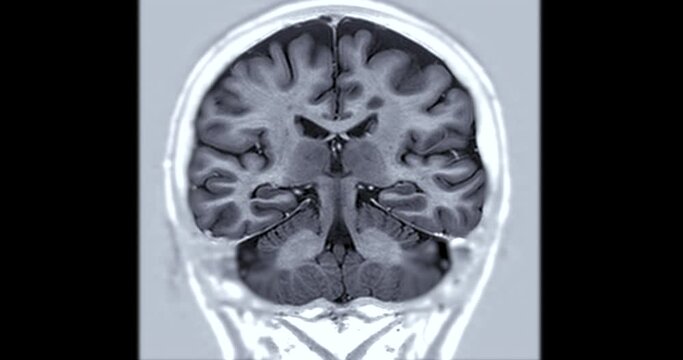 MRI Brain Coronal  oblique can help doctors look for conditions dementia.