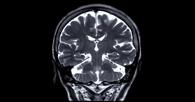 MRI Brain Coronal T2w oblique can help doctors look for conditions dementia.