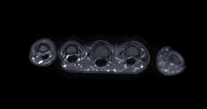 MRI hand T2W Fat suppression for diagnosis bone arthritis , rheumatoid and Tear of ligament.