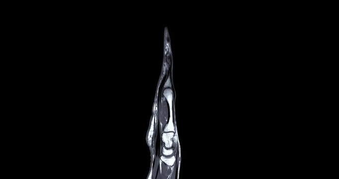 MRI hand T2W for diagnosis bone arthritis , rheumatoid and Tear of ligament.
