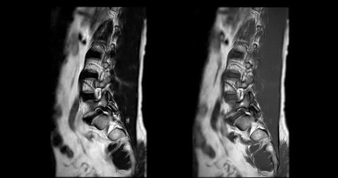 MRI L-S spine or lumbar spine sagittal T1W and T2W for diagnosis spinal cord compression.
