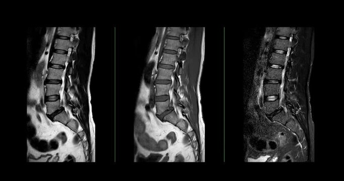 MRI L-S spine or lumbar spine sagittal T2W, T1W and T2W  Fat suppression for diagnosis spinal cord compression.