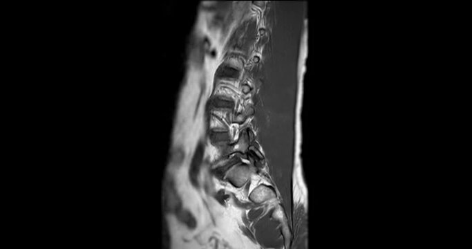 MRI L-S spine or lumbar spine sagittal T1W for diagnosis spinal cord compression.