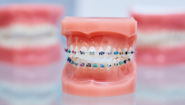 Braces on teeth. lower and upper dental jaw model