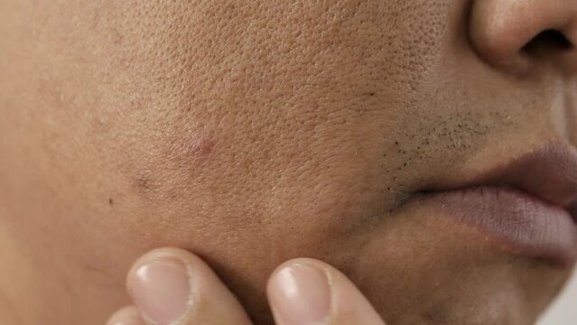 Cheeks of people with skin problems, acne, large pores and dull skin