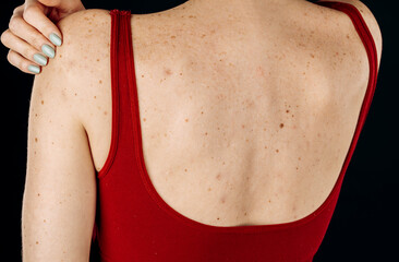 A young woman has pimples with red spots on her back, isolated on a black background, the concept...