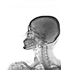 X-ray of neck and cervical spine side view. Image of radiography from patient