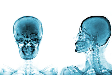 skull x ray isolated on white background  Process in blue tone and have copy space, Medical concept.