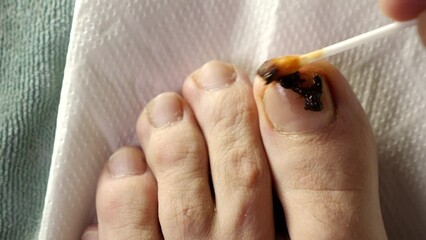 A solution of propolis is applied to the nail affected by the fungus. Treatment of fungal nail diseases.