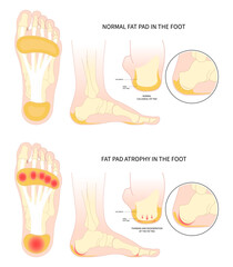 Painful heel bone spurs in Plantar fat pad atrophy tear high ankle shoes feet sport fascia arch of Lupus shots steroid for Achilles tendon © Pepermpron