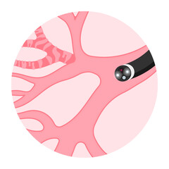 Bronchioles tumor cancer malignant cell surgical with flexible fiber optic guided medical chest X RAY test lymph node masses chronic asthma mucus plug bronchi washing