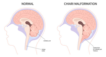 Anatomy of brain with Chiari malformation - obrazy, fototapety, plakaty