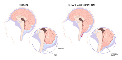 Anatomy of brain cancer tumor bleeding with Chiari malformation - obrazy, fototapety, plakaty