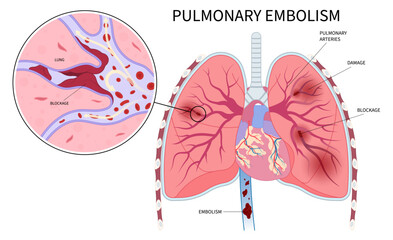 Lung blood clot chronic cough chest pain of leg thrombus air stroke edema spider vein high block vessel arteries acute limb ischemia swelling knee ulcer foot calf post thrombotic