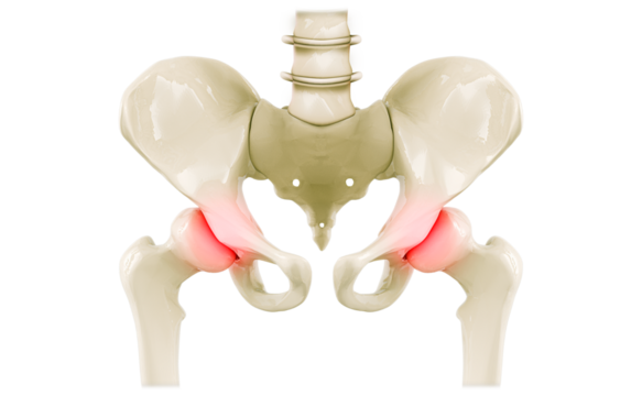 Intense pain in the cartilage joints, femoral head. Pelvis, degenerative hip disease. Inflammation of the joints due to arthritis and osteoarthritis.
