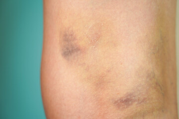A large bruise on a woman's leg below the knee. Brown hematoma on the body